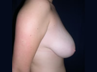 Reduccion y elevación de senos antes
