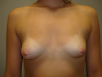 Reduccion y elevación de senos antes
