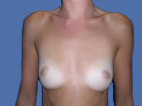 Aumento de senos antes