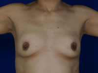 Breast Reconstruction before